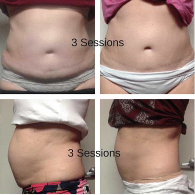 Cavi-Lipo Weight Loss, Bethlehem Tauranga | Pain-Free & Safe